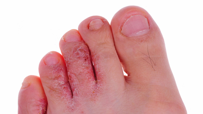 Home Remedies for Athlete's Foot: Natural Solutions for Itchy Feet