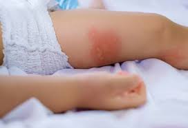 Indian Home Remedies for Eczema in Babies